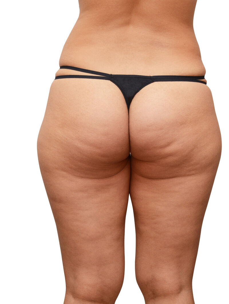 Before — Cellulite Reduction — Real Client Results