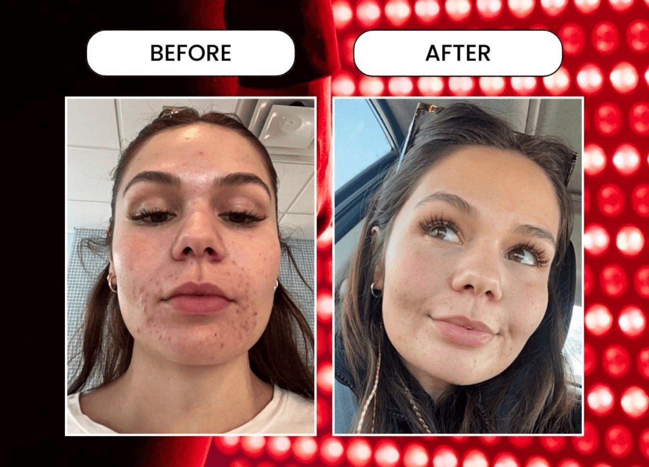 Client skin clarity transformation with Red Light Therapy
